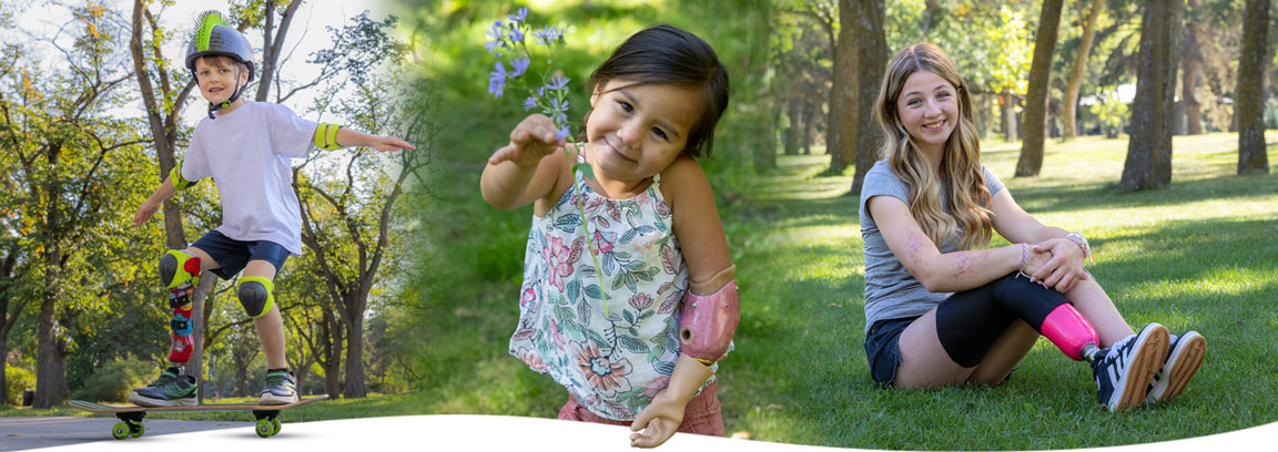 A collage of young amputees outside, all wearing artificial limbs.