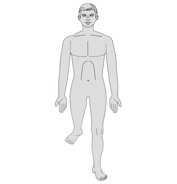 Une illustration anatomique d’un homme ayant une plastie de rotation (plastie de Van Nes).